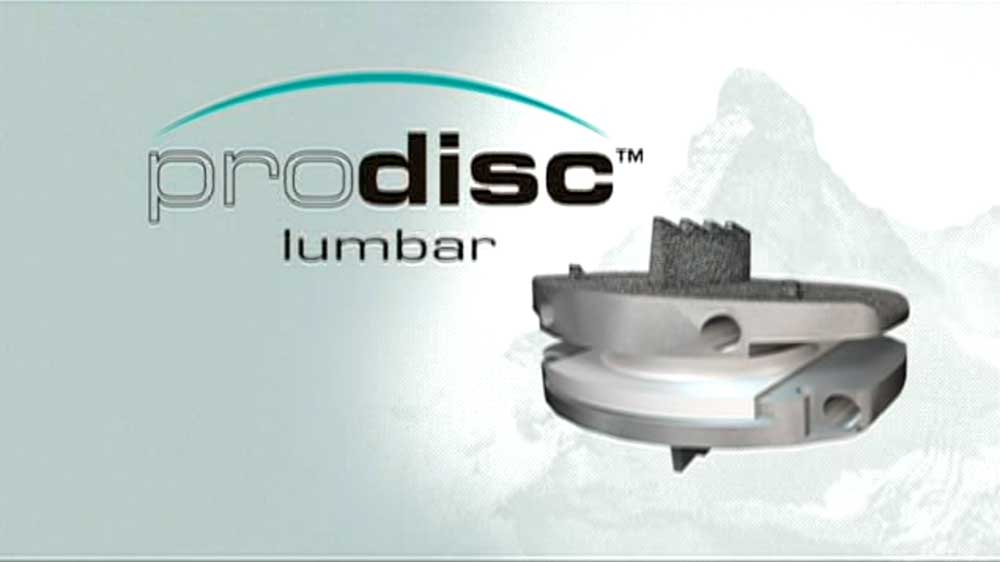 Prodisc-L Lumbar Disc Replacement :: Jeffrey A. Goldstein, MD