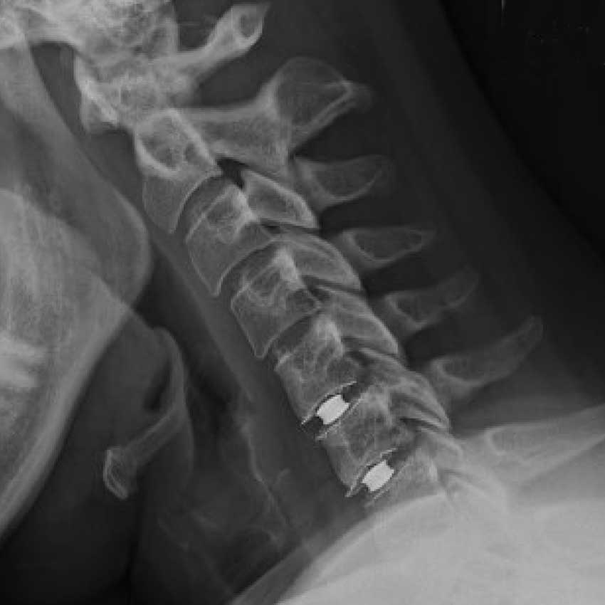 Cervical Artificial Discs :: Jeffrey A. Goldstein, MD